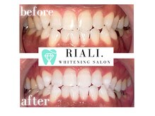 リアリ 宮崎(RIALI.)/プラチナホワイトニング