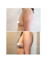 ルフルリール(Refleurir)/◆バストアップ症例/育乳◆