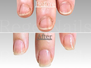 自爪育成・深爪改善コース