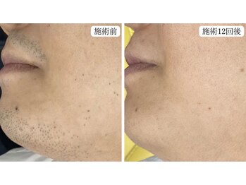 トパーズ 藤枝店(Topaz)/メンズ脱毛 ヒゲ脱毛 藤枝