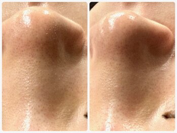 ルクシア(RUXCIA)/ビフォーアフター/毛穴洗浄1回