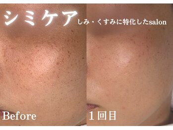フジモトサロン 那覇おもろまち店(fujimotoサロン)/1回施術・シミケア・くすみ改善