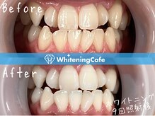 ホワイトニングカフェ 姫路駅前店(WhiteningCafe)/ホワイトニング9回照射