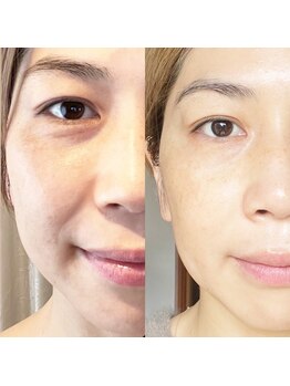 サロンドウルス(salon de ours)/エクソソーム