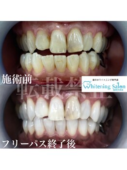 ホワイトニングサロン 福岡天神店/ホワイトニング