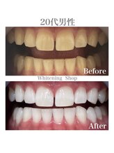 ホワイトニングショップ 広島廿日市店/before&after