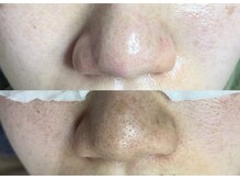 キレイになる路の雰囲気(毛穴の黒ずみを徹底的に除去し、開きを引き締める毛穴お手入れ)