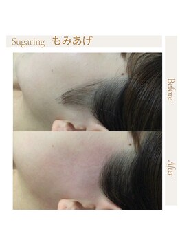エムケーサロン(Mksalon)/シュガーリング脱毛/もみあげ