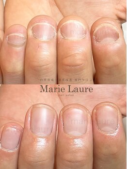 マリーロール 梅田店(Marie Laure)/自爪育成/深爪矯正/ネイルケア
