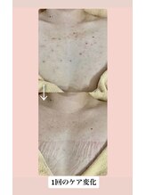 スキンハピネス(skinhappiness)/デコルテハーブピーリング