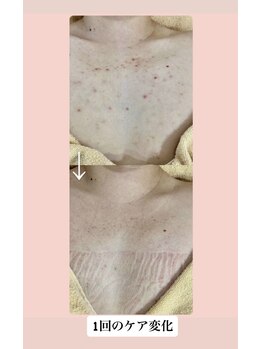 スキンハピネス(skinhappiness)/デコルテハーブピーリング