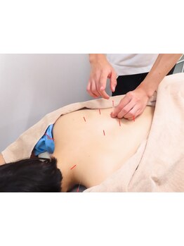 鍼灸施術を受けたい