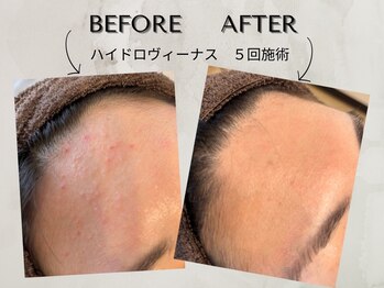 ワンアップ(One-up)/【ハイドロヴィーナス５回施術】