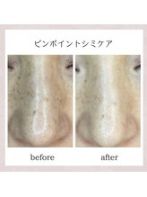 アトリア(ATRIA)/プラズマシミケア