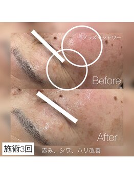 イリス(Iris)/大人の肌弾力を復活させるには