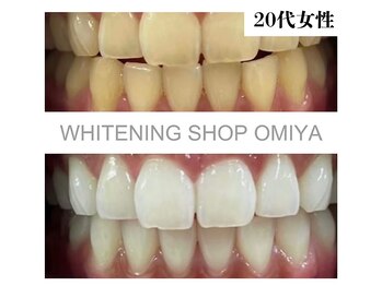 ホワイトニングショップ 大宮店/【事例】　20代　女性