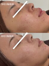 テンニック(10nick)/頬ニキビ改善