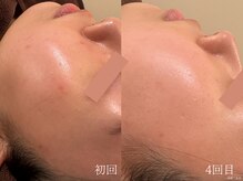 ウォーム(warm)/乾燥/敏感肌/赤み/フェイシャル