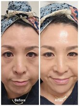 アン 銀座(ann)/オーナー実感たるみ肌からツヤ肌
