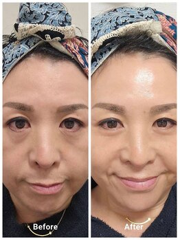アン 銀座(ann)/オーナー実感たるみ肌からツヤ肌