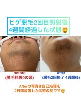 チロル(CHIROL)/ヒゲ脱毛☆2回目の効果