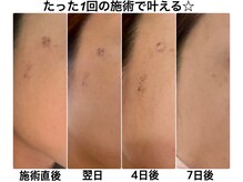 クラルス(clarus)/最新美容機器光フェイシャル