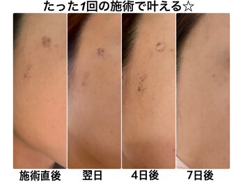 クラルス(clarus)/最新美容機器光フェイシャル