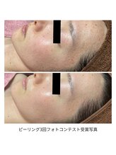 サロンゼロ 池上店(Salon ZERO)/皮膚科学発の肌質改善ピーリング