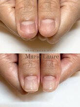 マリーロール 梅田店(Marie Laure)/深爪矯正/自爪育成/自爪風
