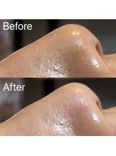 ミミ(mimi)/毛穴にたまった毛も