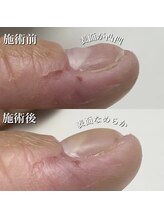 リリー/凹凸爪をツルツルに！