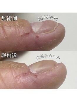 リリー/凹凸爪をツルツルに！