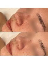 ビオプラス(BioPlus+)/ハーブピーリング/川崎