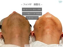 サラ 恵比寿店(SARA)/ヒゲ脱毛/ビフォーアフター