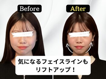 ハリユナイテッド 原宿鍼灸 整体院(HALI UNITED)/肩こり改善で劇的リフトアップ