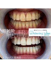 ホワイトニングサロン 福岡天神店/ホワイトニング