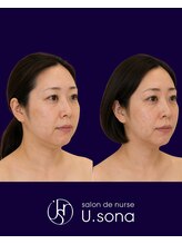 小顔・脂肪コントロール専門 salon de nurse U.sona～松本店～/【顔造形】40代脂肪分解症例