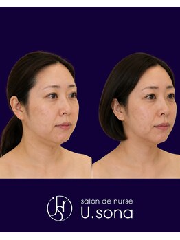 小顔・脂肪コントロール専門 salon de nurse U.sona～松本店～/【顔造形】40代脂肪分解症例
