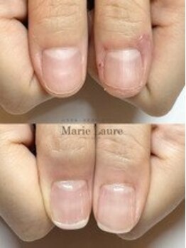 マリーロール 梅田店(Marie Laure)/自爪育成/深爪矯正/ネイルケア
