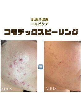 アイリス(AIRIS)/肌荒れ改善コモデックス