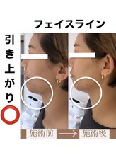 ブルーシー(BLUESEA)/エレクトロポレーション