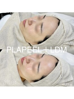 イロハ(IROHA)/プラピール×LDM