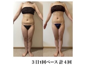 アーク(ARC)/上半身痩身60分 before/after