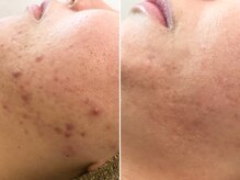 ハダイ(HADAY)/ニキビ改善｜ハーブピーリング