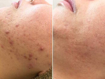 ハダイ(HADAY)/ニキビ改善｜ハーブピーリング