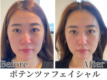 フェミナ(femna)/たるみ・老け顔・くすみに★