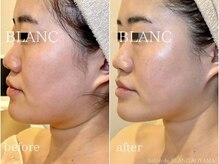 サロン ド ブラン アオヤマ(Salon de BLANC AOYAMA)/クリスティーナ美白×ソノケア