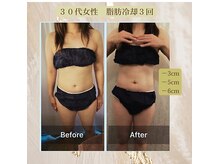ラベージャ(La Bella)/３０代女性　脂肪冷却