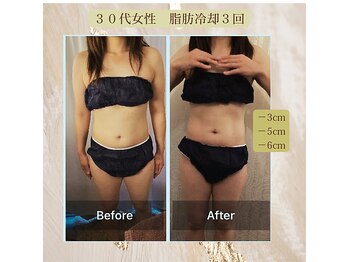 ラベージャ(La Bella)/３０代女性　脂肪冷却