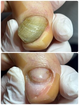 プラスキュア 用賀店(+CURE)/肥厚爪 変形爪 副爪 60分6600~